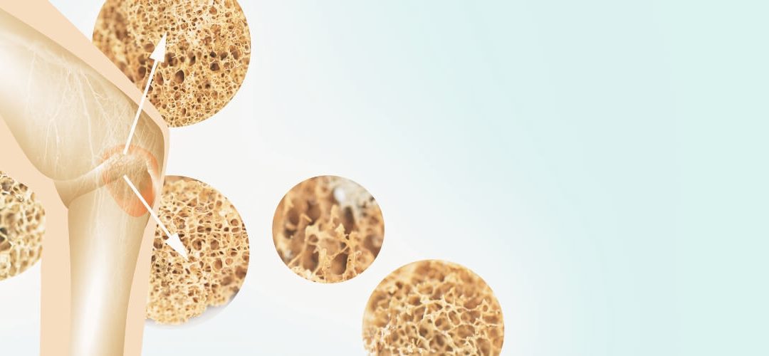 Optimising Bone Health with Osteoporosis