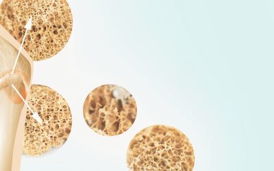 Optimising Bone Health with Osteoporosis